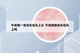 牛皮癬一定會長在頭上么 牛皮膚癬會長在頭上嗎