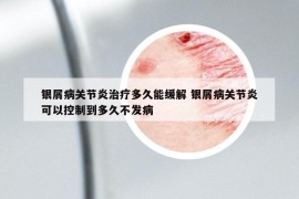 銀屑病關(guān)節(jié)炎治療多久能緩解 銀屑病關(guān)節(jié)炎可以控制到多久不發(fā)病