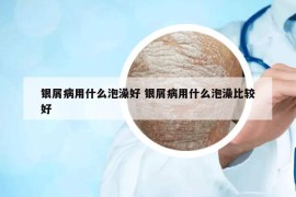 銀屑病用什么泡澡好 銀屑病用什么泡澡比較好