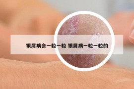 銀屑病會一粒一粒 銀屑病一粒一粒的