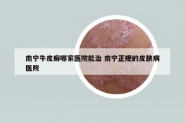 南寧牛皮癬哪家醫(yī)院能治 南寧正規(guī)的皮膚病醫(yī)院