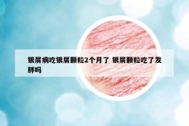 銀屑病吃銀屑顆粒2個月了 銀屑顆粒吃了發(fā)胖嗎