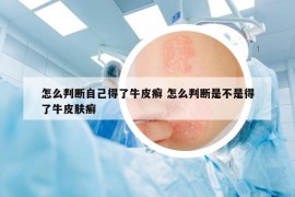 怎么判斷自己得了牛皮癬 怎么判斷是不是得了牛皮膚癬
