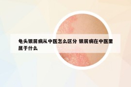 龜頭銀屑病從中醫(yī)怎么區(qū)分 銀屑病在中醫(yī)里屬于什么