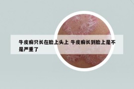 牛皮癬只長(zhǎng)在臉上頭上 牛皮癬長(zhǎng)到臉上是不是嚴(yán)重了