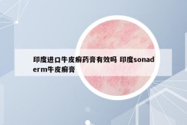 印度進(jìn)口牛皮癬藥膏有效嗎 印度sonaderm牛皮癬膏