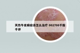 天熱牛皮癬應該怎么治療 002708千股千評