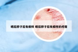 曬后脖子后有癬樣 曬后脖子后有癬樣的疙瘩