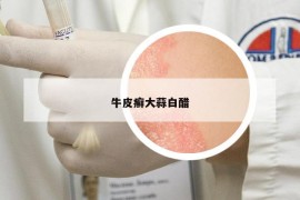 牛皮癬大蒜白醋