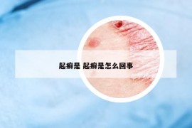 起癬是 起癬是怎么回事