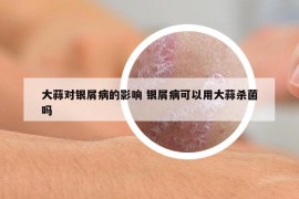 大蒜對銀屑病的影響 銀屑病可以用大蒜殺菌嗎