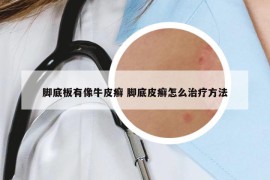 腳底板有像牛皮癬 腳底皮癬怎么治療方法