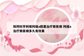 如何科學利用阿維a膠囊治療銀屑病 阿維a治療銀屑病多久有效果