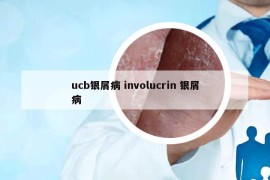 ucb銀屑病 involucrin 銀屑病