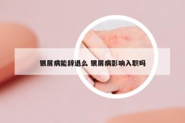 銀屑病能辭退么 銀屑病影響入職嗎
