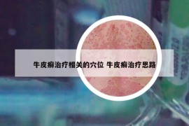 牛皮癬治療相關(guān)的穴位 牛皮癬治療思路