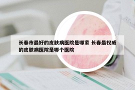 長春市最好的皮膚病醫(yī)院是哪家 長春最權(quán)威的皮膚病醫(yī)院是哪個醫(yī)院