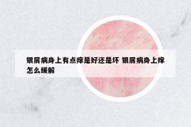銀屑病身上有點(diǎn)癢是好還是壞 銀屑病身上癢怎么緩解