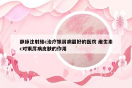 靜脈注射維c治療銀屑病最好的醫(yī)院 維生素c對(duì)銀屑病皮膚的作用