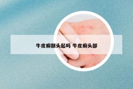牛皮癬額頭起嗎 牛皮癬頭部