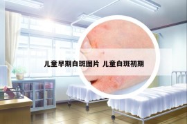 兒童早期白斑圖片 兒童白斑初期