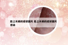 臉上長癬的癥狀圖片 臉上長癬的癥狀圖片 感染