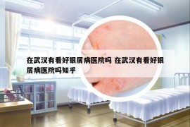 在武漢有看好銀屑病醫(yī)院嗎 在武漢有看好銀屑病醫(yī)院嗎知乎