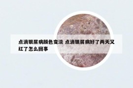 點(diǎn)滴銀屑病顏色變淡 點(diǎn)滴銀屑病好了兩天又紅了怎么回事