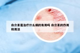 白介素是治療什么病的有用嗎 白介素的作用和用法
