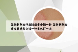 生物制劑治療皮膚病多少錢一針 生物制劑治療皮膚病多少錢一針多久打一次