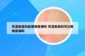 風濕免疫科能看銀屑病嗎 風濕免疫科可以看銀屑病嗎