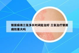 銀屑癬用三氧多長時(shí)間能治好 三氧治療銀屑病效果大嗎