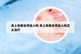 身上有癬會傳染人嗎 身上有癬會傳染人嗎怎么治療