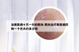 治銀屑病十萬一針的靶向 靶向治療銀屑病藥物一個(gè)月大約多少錢