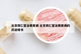 北京同仁堂治銀屑病 北京同仁堂治銀屑病的藥說明書