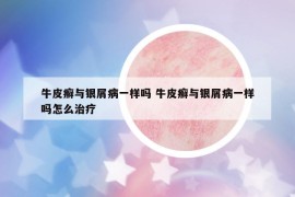 牛皮癬與銀屑病一樣嗎 牛皮癬與銀屑病一樣嗎怎么治療