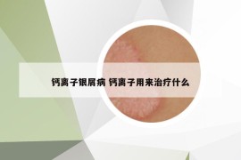 鈣離子銀屑病 鈣離子用來治療什么