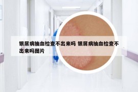 銀屑病抽血檢查不出來(lái)嗎 銀屑病抽血檢查不出來(lái)嗎圖片