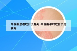 牛皮癬患者吃什么最好 牛皮癬平時(shí)吃什么比較好