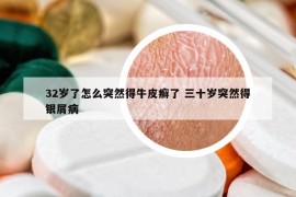 32歲了怎么突然得牛皮癬了 三十歲突然得銀屑病