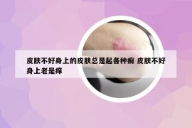 皮膚不好身上的皮膚總是起各種癬 皮膚不好身上老是癢