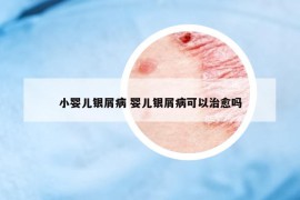 小嬰兒銀屑病 嬰兒銀屑病可以治愈嗎