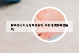 抹蘆薈可以治療牛皮癬嗎 蘆薈可以擦牛皮癬嗎