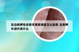 左邊肩胛處皮膚生銀屑病是怎么回事 左肩胛長(zhǎng)痣代表什么