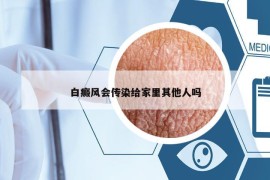 白癜風(fēng)會(huì)傳染給家里其他人嗎