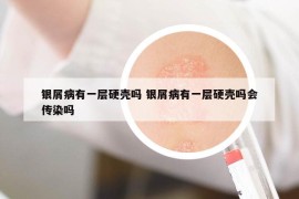 銀屑病有一層硬殼嗎 銀屑病有一層硬殼嗎會(huì)傳染嗎