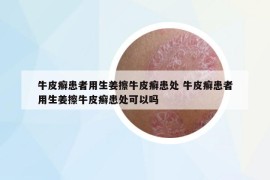 牛皮癬患者用生姜擦牛皮癬患處 牛皮癬患者用生姜擦牛皮癬患處可以嗎