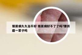 銀屑病久久治不好 銀屑病好不了了嗎?要折磨一輩子嗎
