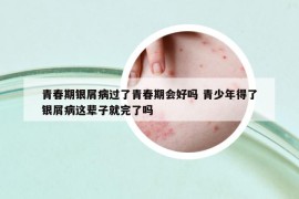 青春期銀屑病過(guò)了青春期會(huì)好嗎 青少年得了銀屑病這輩子就完了嗎