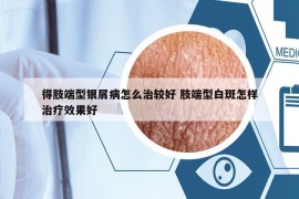 得肢端型銀屑病怎么治較好 肢端型白斑怎樣治療效果好